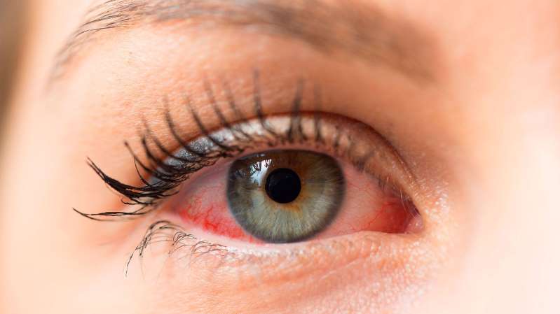 Coronavirus y conjuntivitis: dos nuevos estudios sugieren que la enfermedad podría manifestarse con síntomas oculares